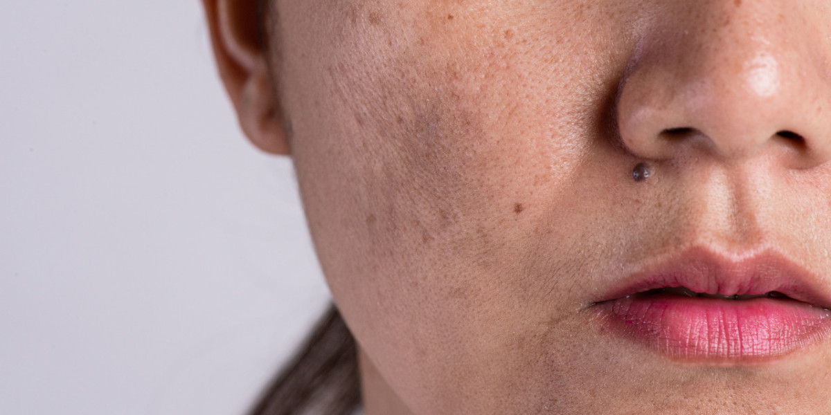 Restore Radiance with Melasma Therapy